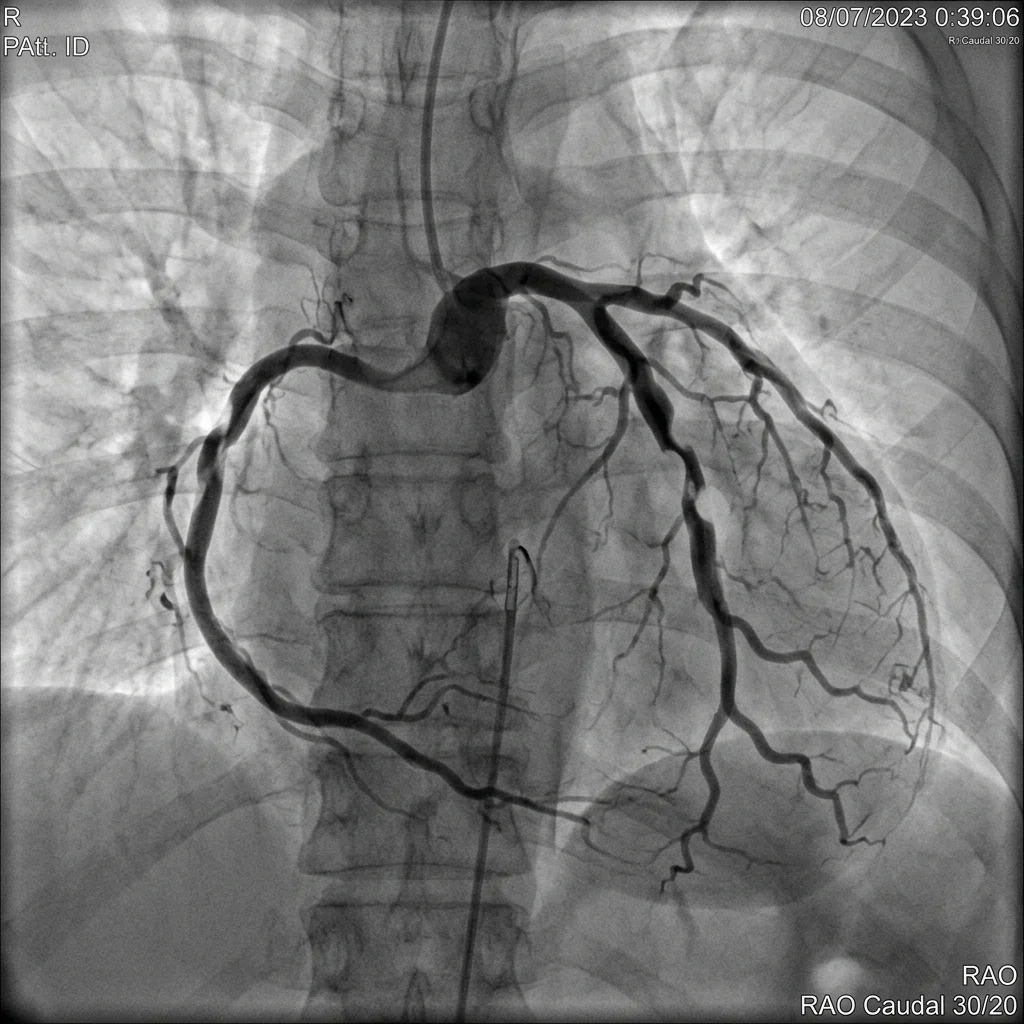 Coronary Angiography: What To Expect From Your Procedure