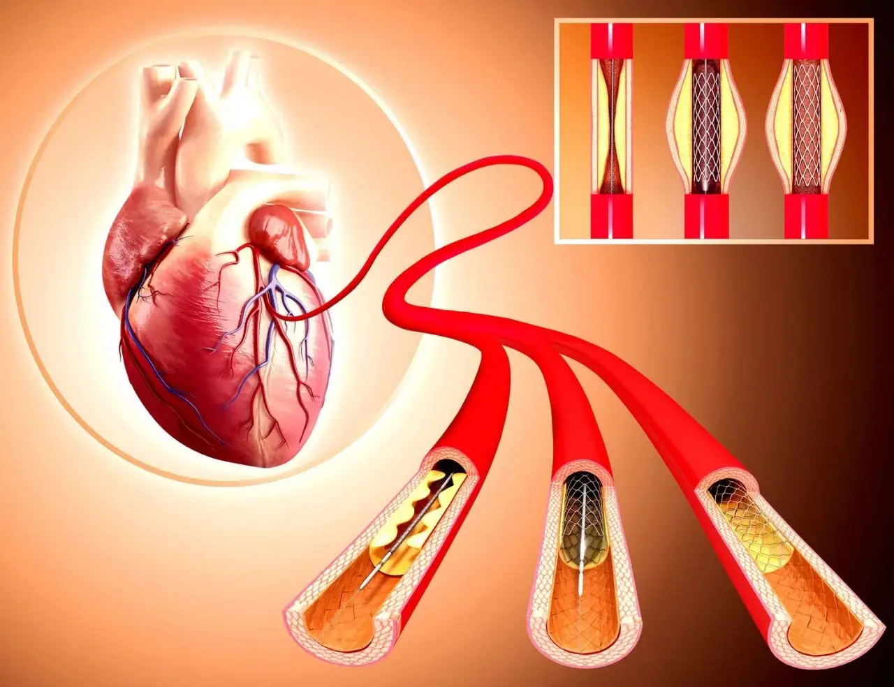 Angioplasty & Stenting