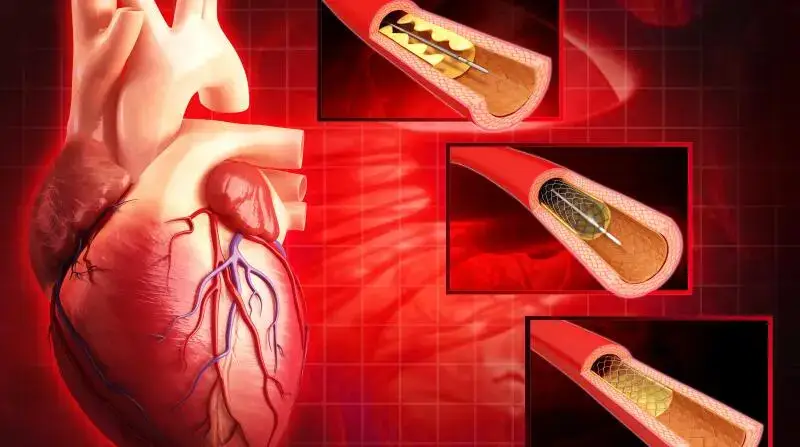 Cardiac Catheterisation